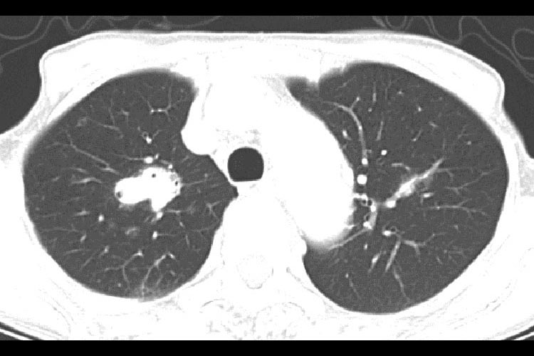 リンパ増殖性疾患：多発性肺浮腫癌図1