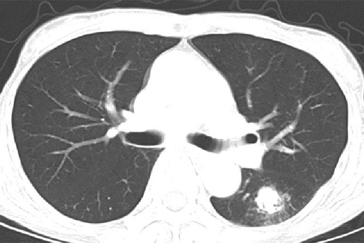 リンパ増殖性疾患：多発性肺浮腫癌図2