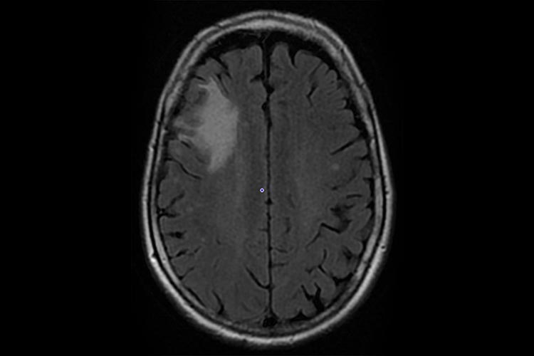 リンパ増殖性疾患：多発性脳腫癌図1